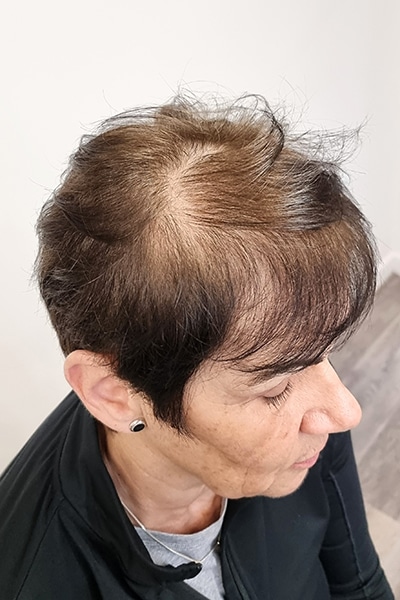 Scalp Micropigmentation (SMP) in Norwich, Norfolk