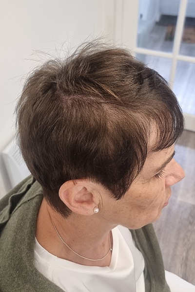 Scalp Micropigmentation (SMP) in Norwich, Norfolk