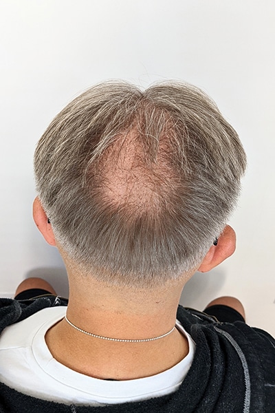 Scalp Micropigmentation (SMP) in Norwich, Norfolk