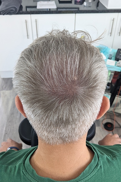 Scalp Micropigmentation (SMP) in Norwich, Norfolk