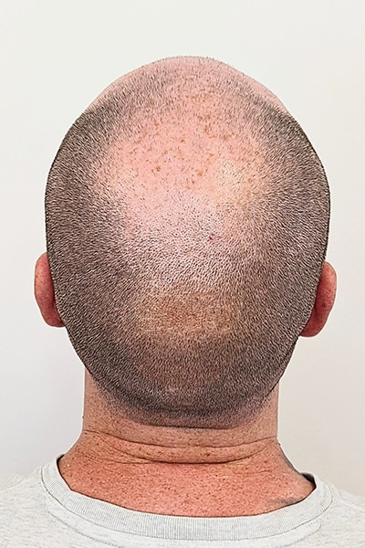 Scalp Micropigmentation (SMP) in Norwich, Norfolk