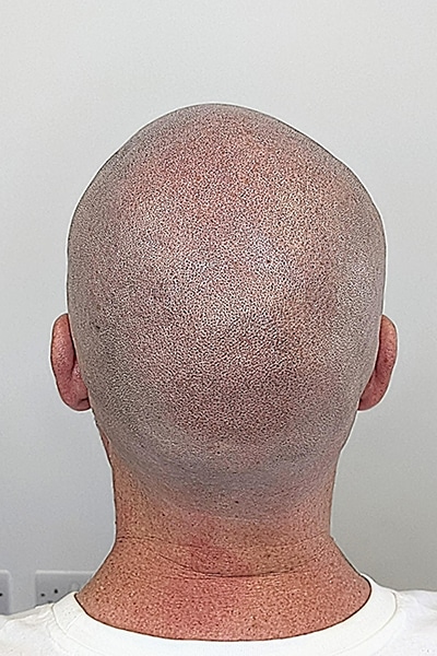 Scalp Micropigmentation (SMP) in Norwich, Norfolk