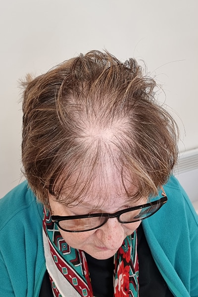 Scalp Micropigmentation (SMP) in Norwich, Norfolk