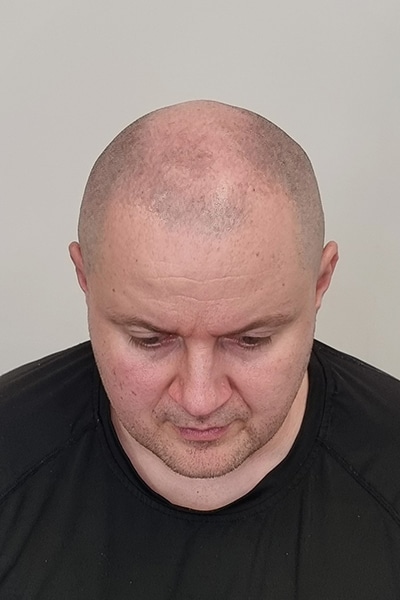 Scalp Micropigmentation (SMP) in Norwich, Norfolk