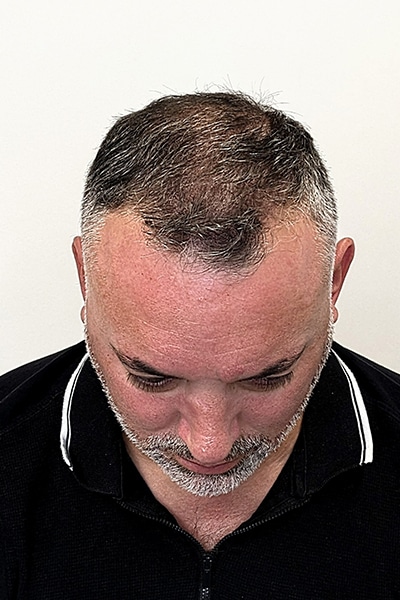 Scalp Micropigmentation (SMP) in Norwich, Norfolk