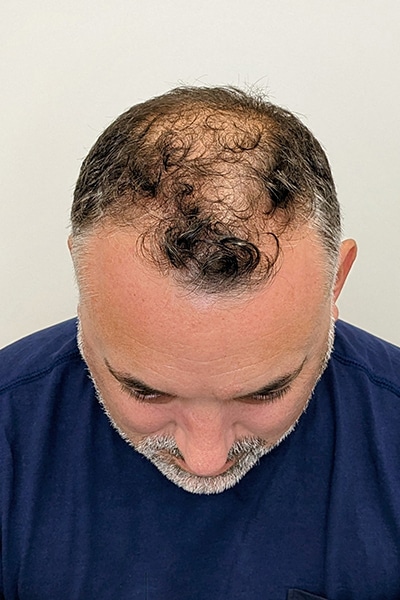 Scalp Micropigmentation (SMP) in Norwich, Norfolk