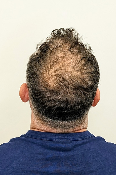 Scalp Micropigmentation (SMP) in Norwich, Norfolk