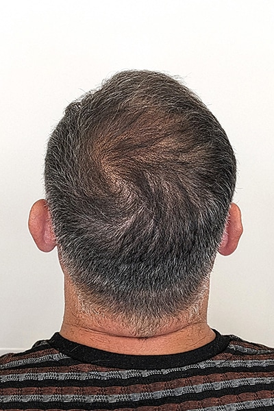 Scalp Micropigmentation (SMP) in Norwich, Norfolk