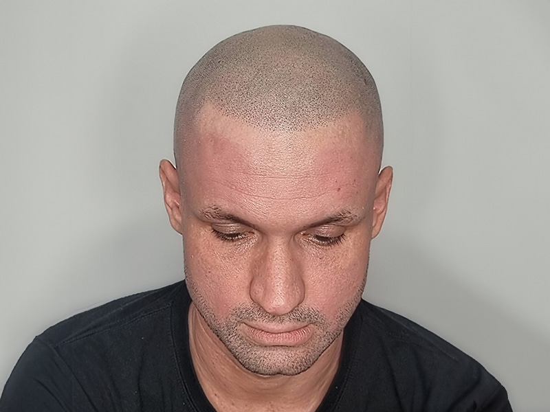 Scalp Micropigmentation (SMP) in Norwich, Norfolk