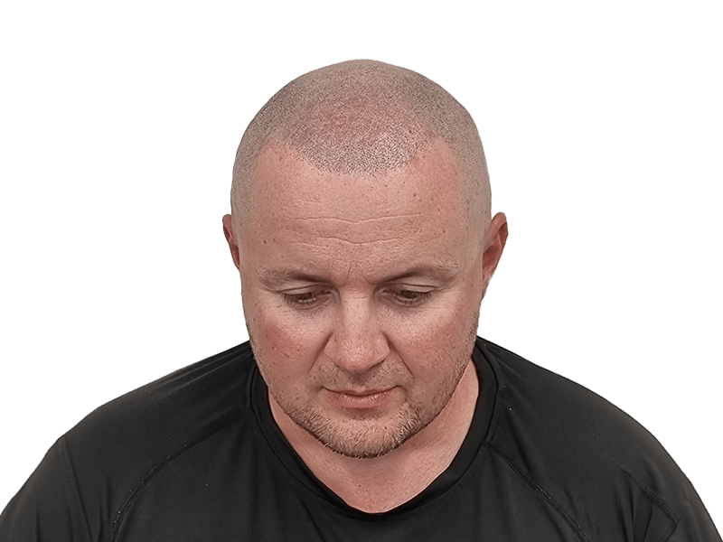 Scalp Micropigmentation (SMP) in Norwich, Norfolk