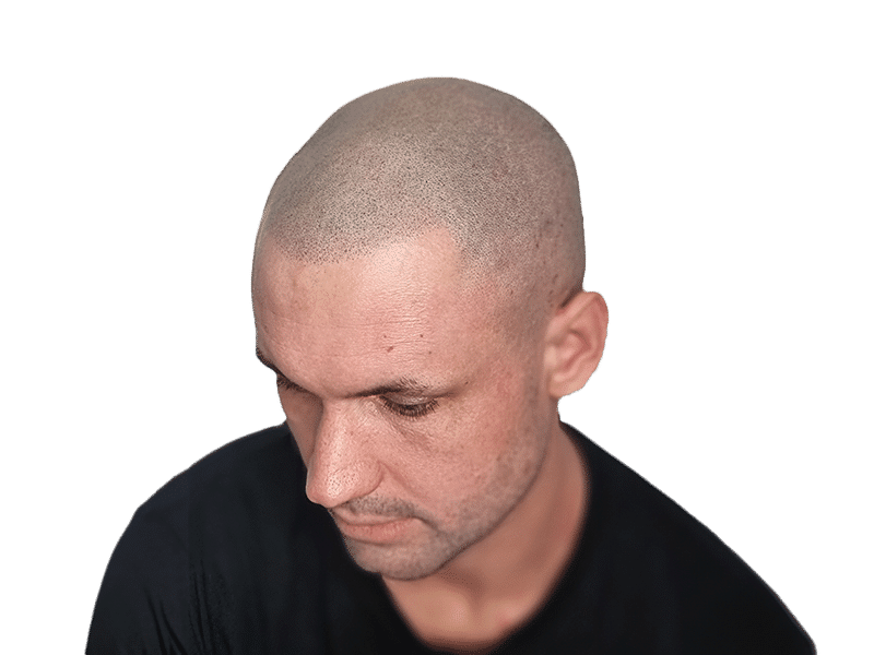 Scalp Micropigmentation (SMP) in Norwich, Norfolk