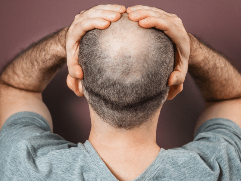 Guide to Scalp Micropigmentation