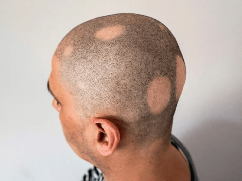 Alopecia of the scalp